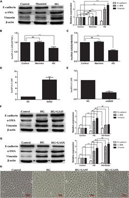 LncRNA GAS5 Competitively Combined With miR-21 Regulates PTEN and Influences EMT of Peritoneal Mesothelial Cells via Wnt/β-Catenin Signaling Pathway